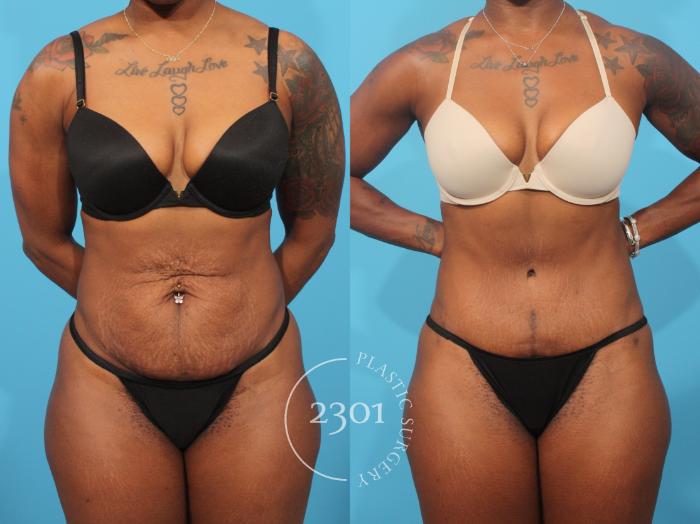 Before & After Tummy Tuck Case 868 Front View in Fort Worth, Plano, & Frisco, Texas