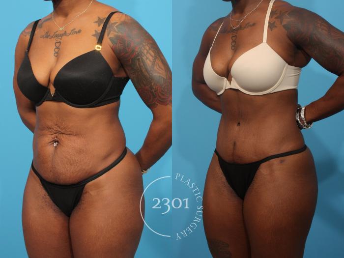 Before & After Tummy Tuck Case 868 Left Oblique View in Fort Worth, Plano, & Frisco, Texas