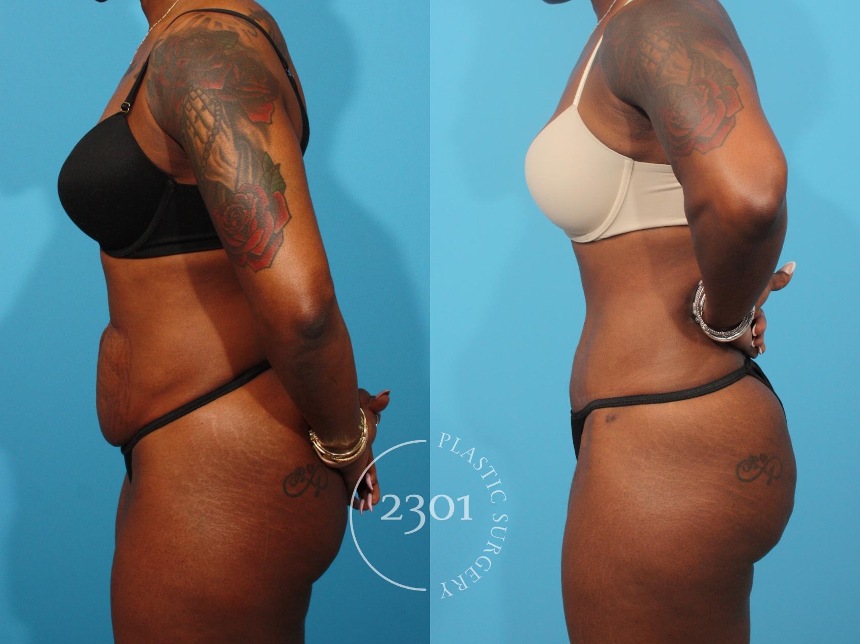 Before & After Tummy Tuck Case 868 Left Side View in Fort Worth, Plano, & Frisco, Texas
