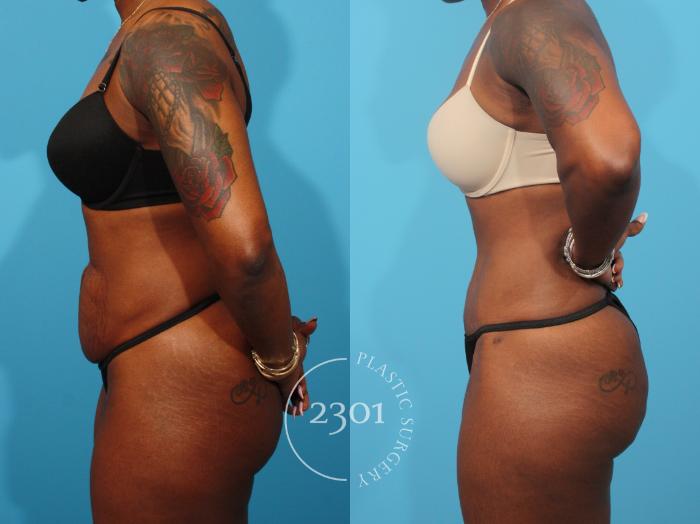 Before & After Tummy Tuck Case 868 Left Side View in Fort Worth, Plano, & Frisco, Texas