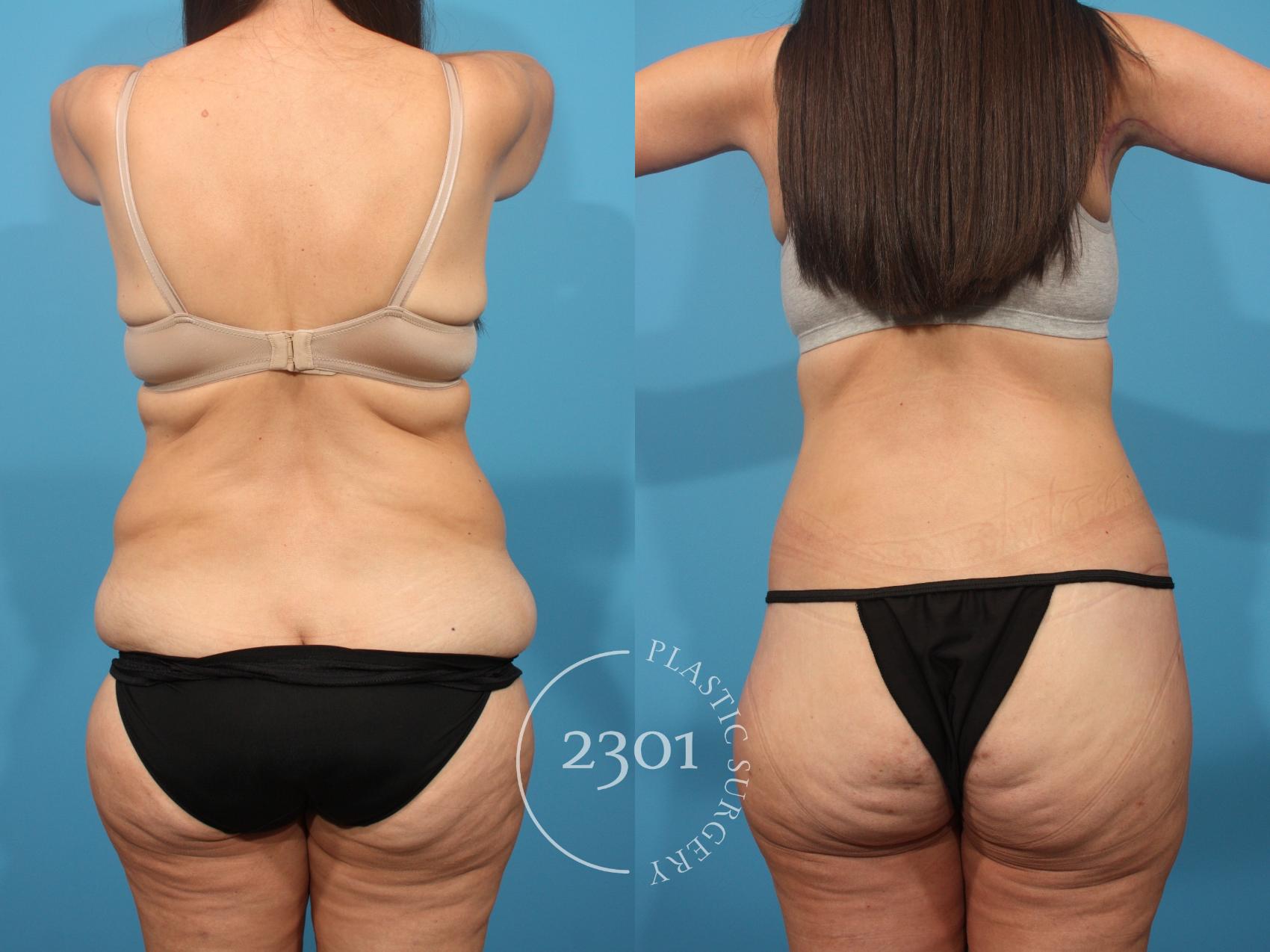 Before & After Tummy Tuck - Extended Case 875 Back View in Fort Worth, Plano, & Frisco, Texas