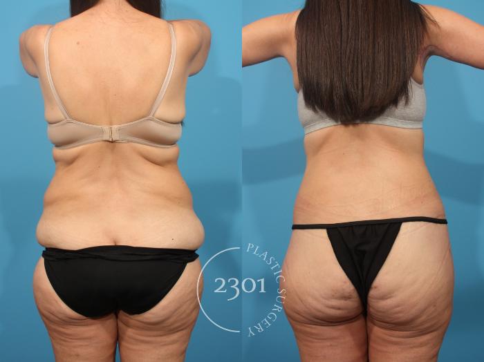 Before & After Tummy Tuck Case 875 Back View in Fort Worth, Plano, & Frisco, Texas