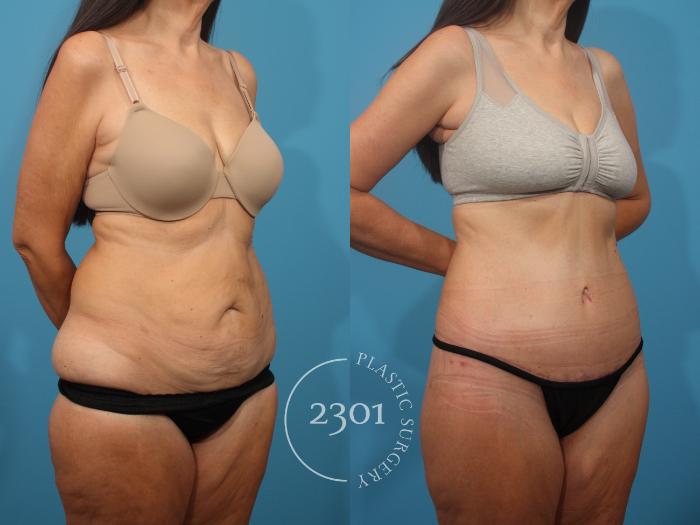 Before & After Tummy Tuck Case 875 Right Oblique View in Fort Worth, Plano, & Frisco, Texas