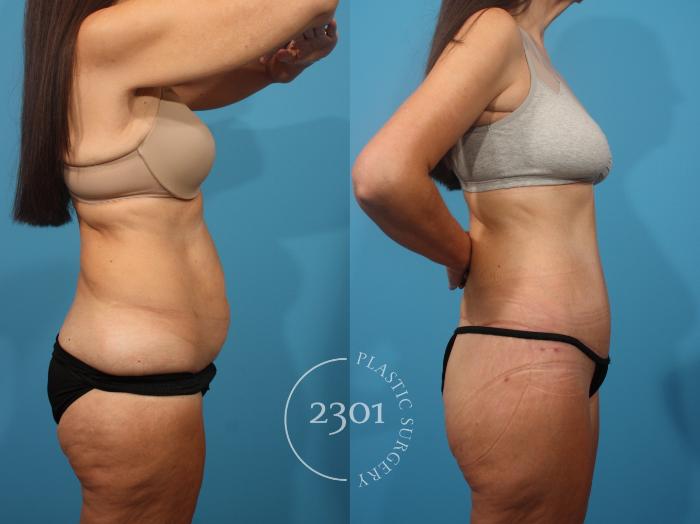 Before & After Tummy Tuck Case 875 Right Side View in Fort Worth, Plano, & Frisco, Texas
