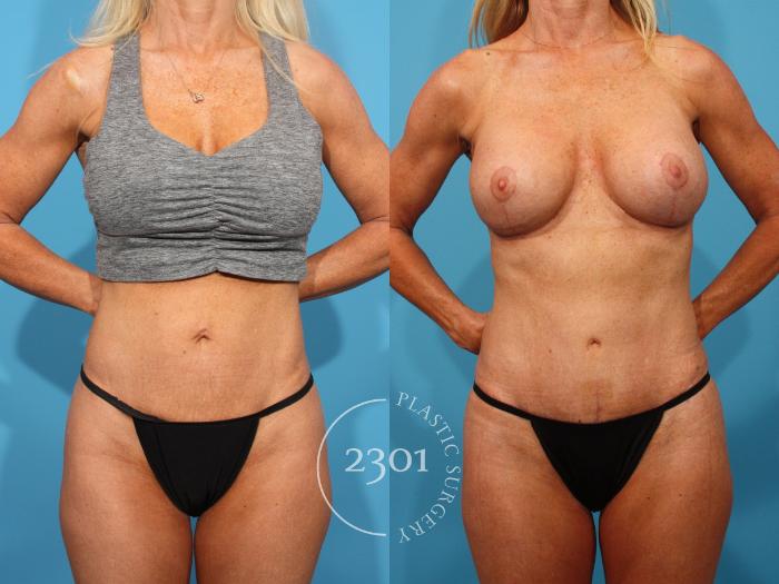 Before & After Mommy Makeover Case 891 Front View in Fort Worth, Plano, & Frisco, Texas