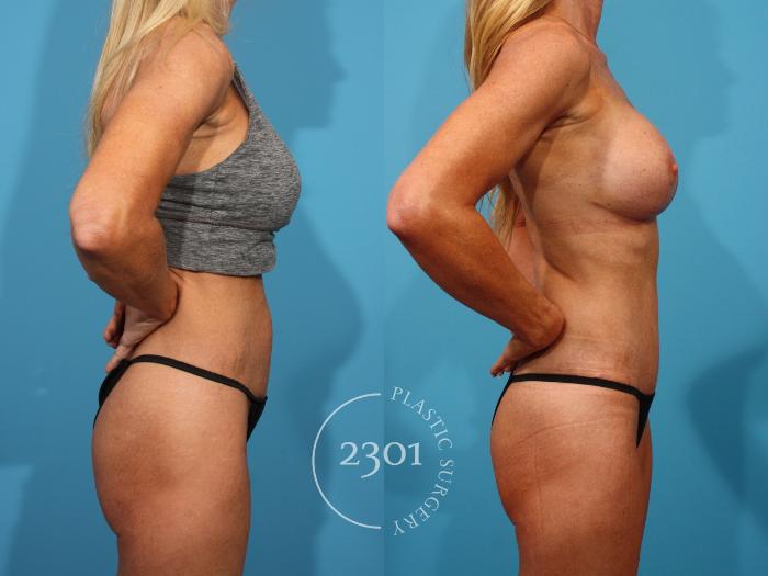 Before & After Mommy Makeover Case 891 Right Side View in Fort Worth, Plano, & Frisco, Texas