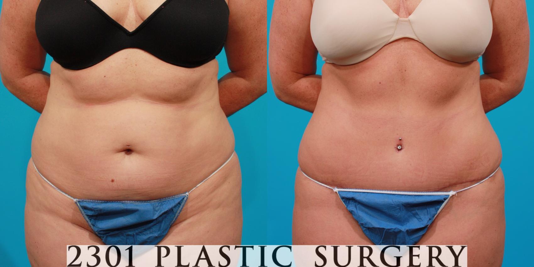 Before & After Tummy Tuck Case 90 View #1 View in Fort Worth, Plano, & Frisco, Texas