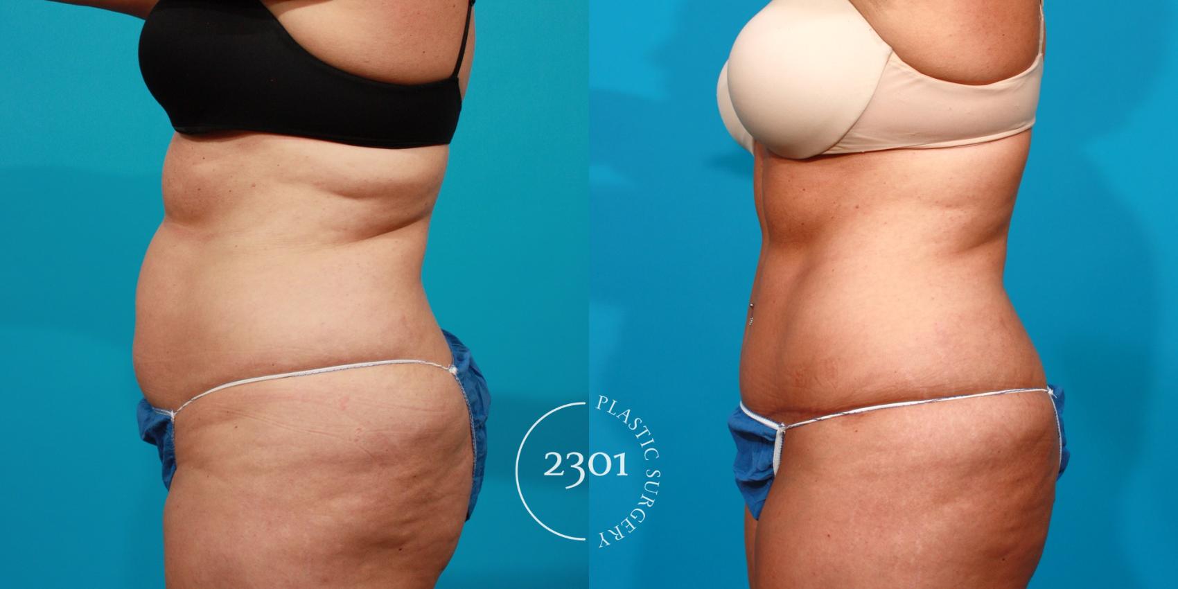 Before & After Tummy Tuck Case 90 View #2 View in Fort Worth, Plano, & Frisco, Texas