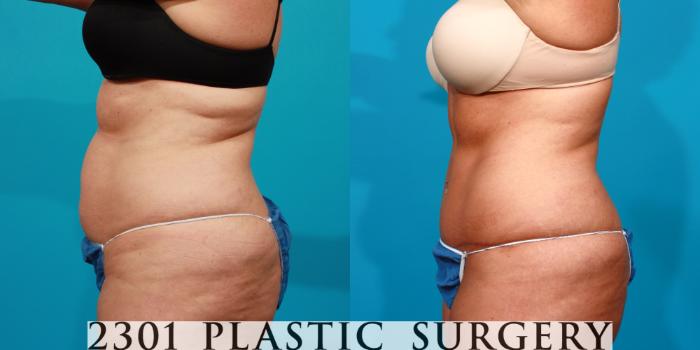 Before & After Tummy Tuck Case 90 View #2 View in Fort Worth, Plano, & Frisco, Texas