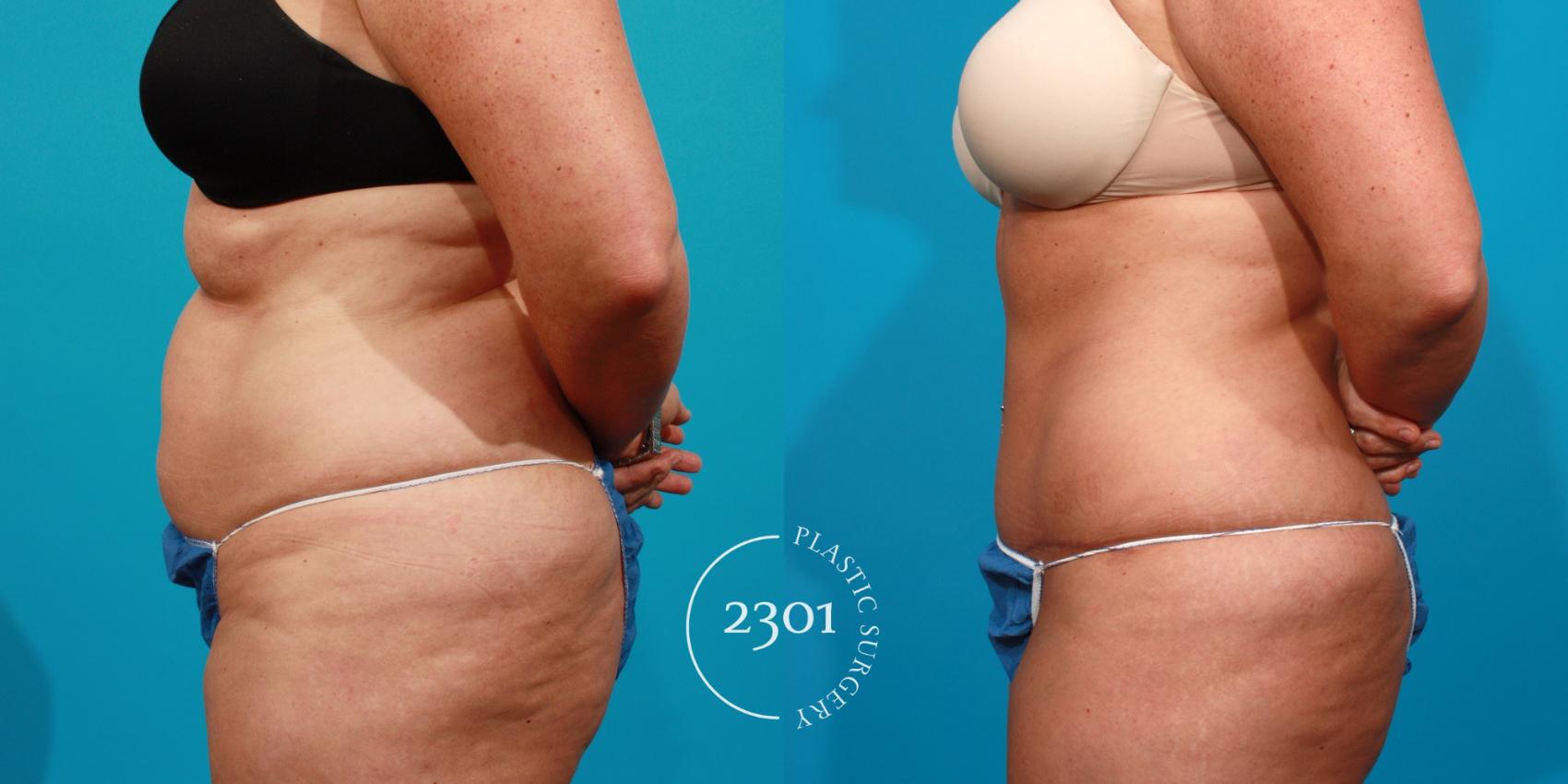 Before & After Tummy Tuck Case 90 View #3 View in Fort Worth, Plano, & Frisco, Texas