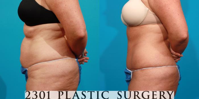 Before & After Tummy Tuck Case 90 View #3 View in Fort Worth, Plano, & Frisco, Texas
