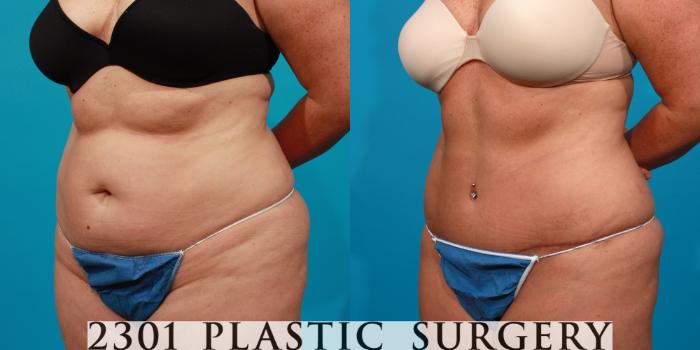 Before & After Tummy Tuck Case 90 View #4 View in Fort Worth, Plano, & Frisco, Texas
