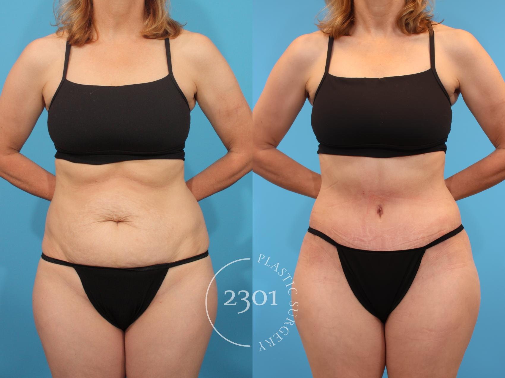 Before & After Tummy Tuck Case 904 Front View in Fort Worth, Plano, & Frisco, Texas