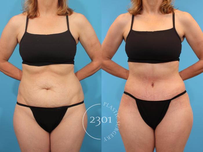 Before & After Tummy Tuck Case 904 Front View in Fort Worth, Plano, & Frisco, Texas