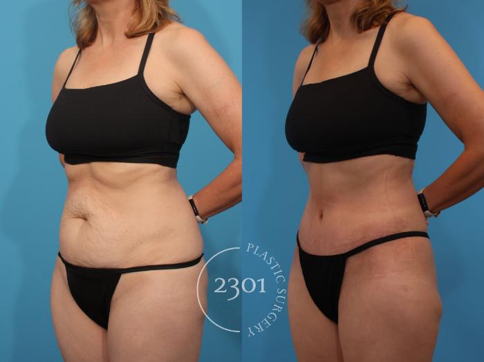 Before & After Tummy Tuck Case 904 Left Oblique View in Fort Worth, Plano, & Frisco, Texas