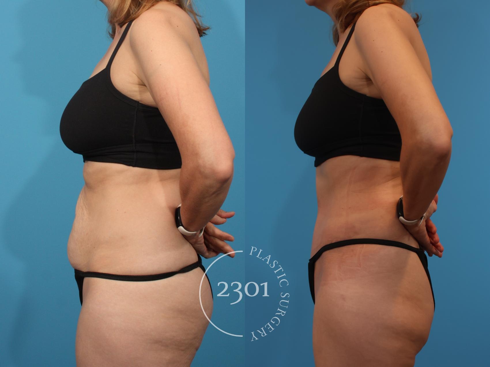 Before & After Tummy Tuck Case 904 Left Side View in Fort Worth, Plano, & Frisco, Texas