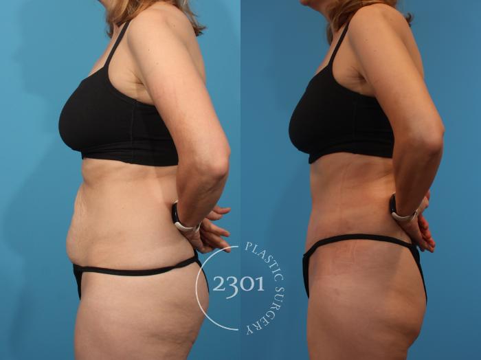 Before & After Tummy Tuck Case 904 Left Side View in Fort Worth, Plano, & Frisco, Texas