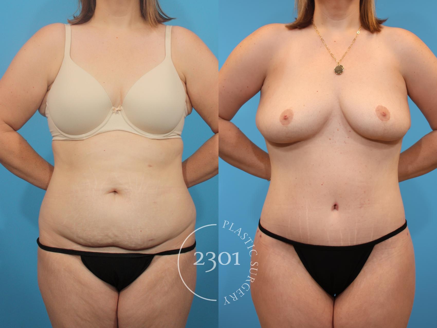 Before & After Tummy Tuck Case 905 Front View in Fort Worth, Plano, & Frisco, Texas
