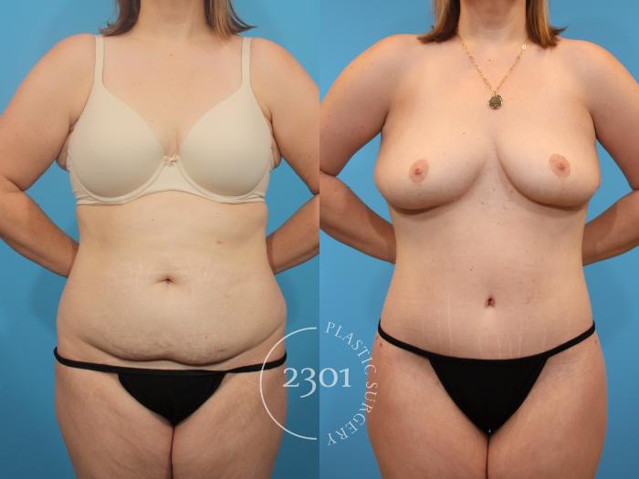 Before & After Tummy Tuck Case 905 Front View in Fort Worth, Plano, & Frisco, Texas
