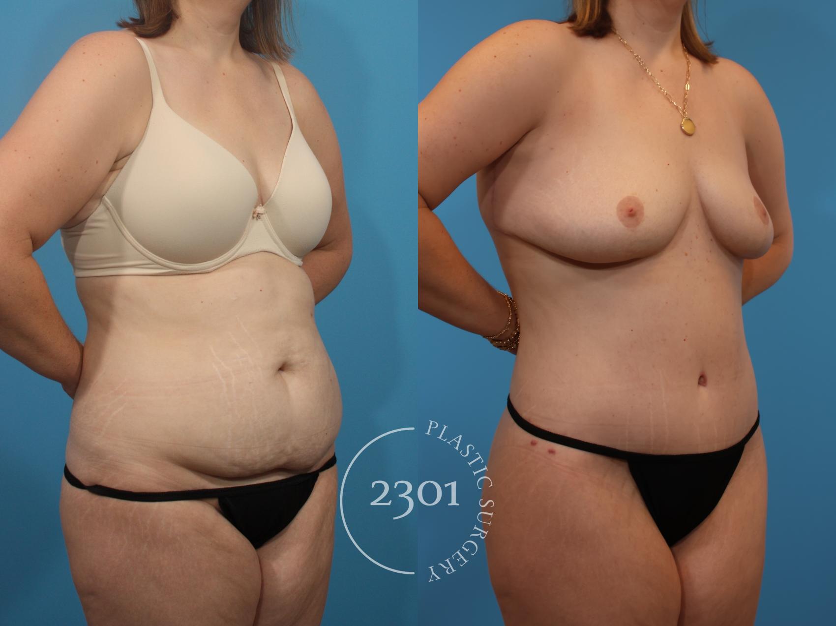 Before & After Tummy Tuck Case 905 Right Oblique View in Fort Worth, Plano, & Frisco, Texas