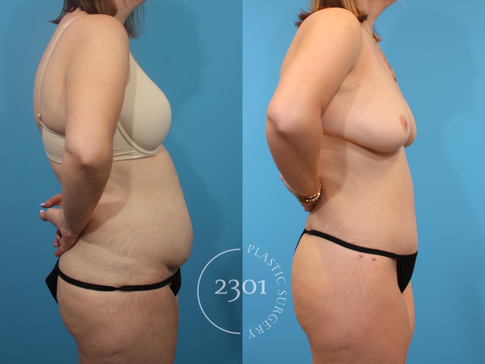 Before & After Tummy Tuck Case 905 Right Side View in Fort Worth, Plano, & Frisco, Texas