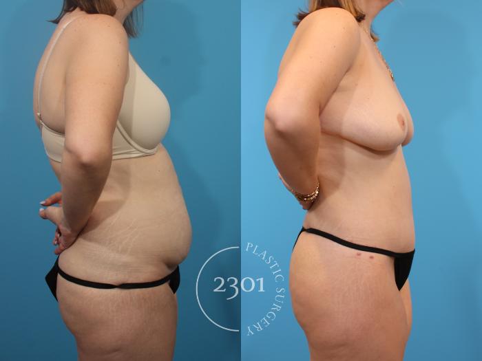 Before & After Tummy Tuck Case 905 Right Side View in Fort Worth, Plano, & Frisco, Texas