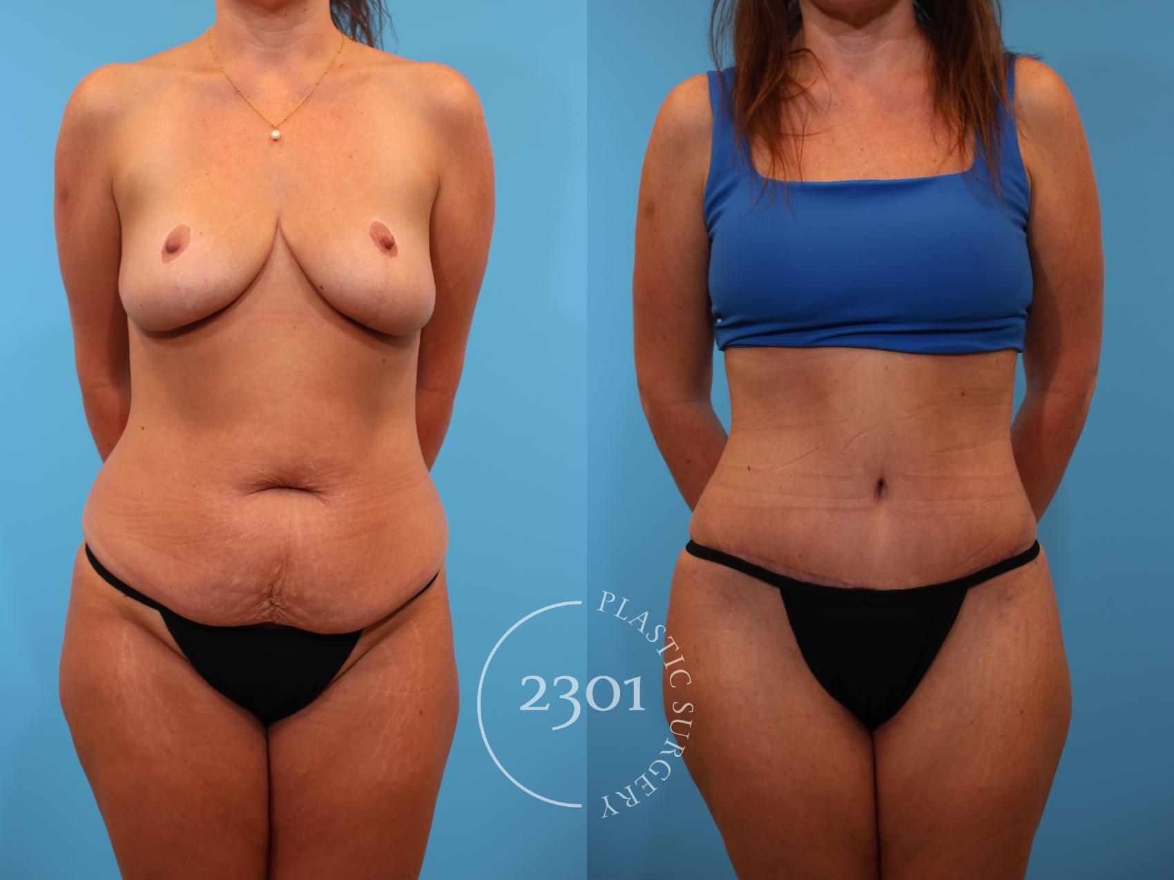 Before & After Tummy Tuck Case 913 Front View in Fort Worth, Plano, & Frisco, Texas