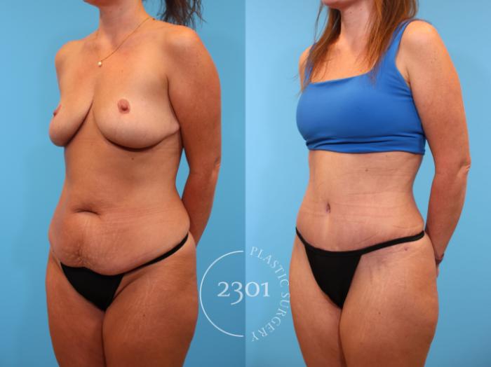 Before & After Tummy Tuck Case 913 Left Oblique View in Fort Worth, Plano, & Frisco, Texas