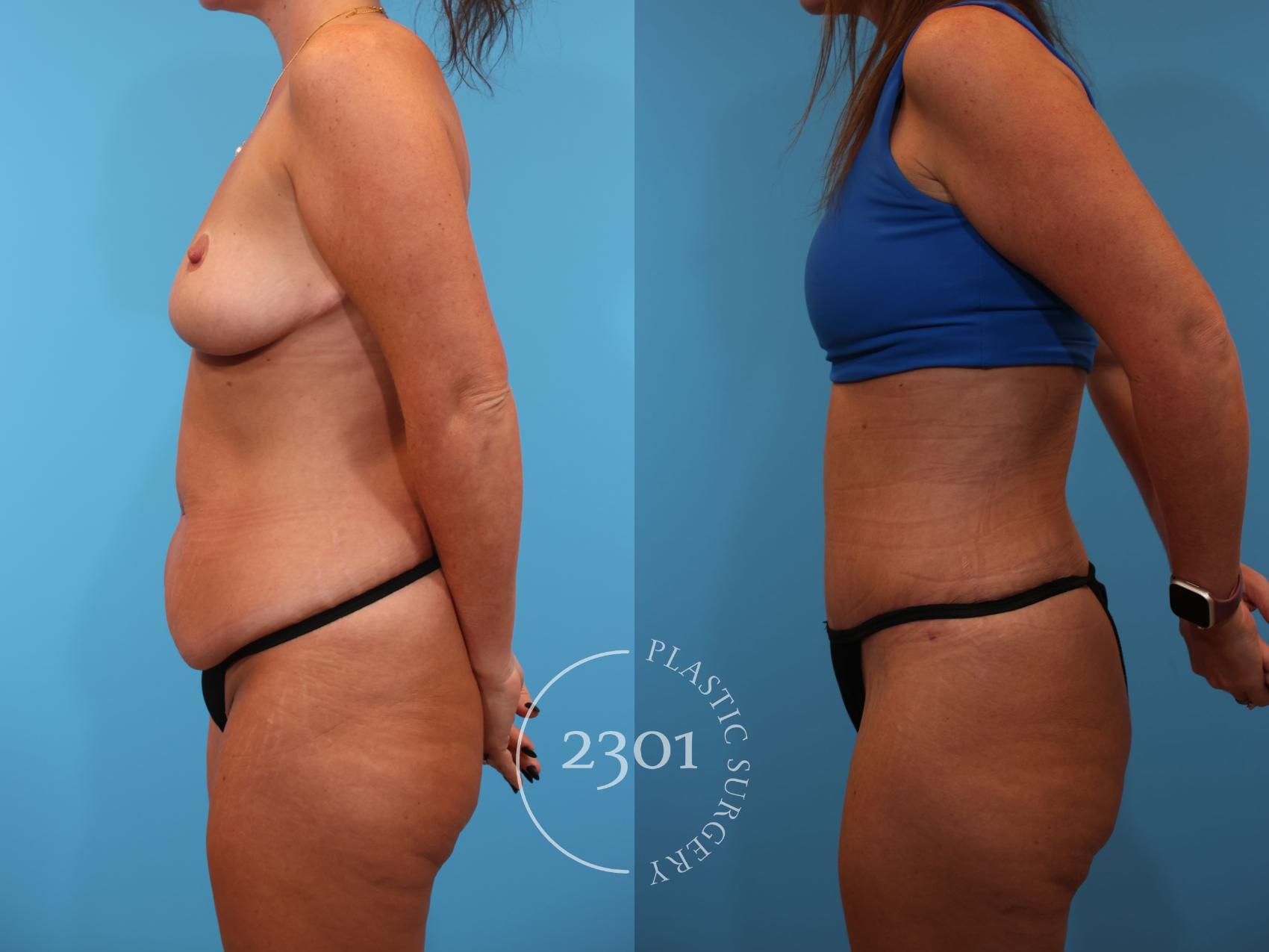 Before & After Tummy Tuck Case 913 Left Side View in Fort Worth, Plano, & Frisco, Texas