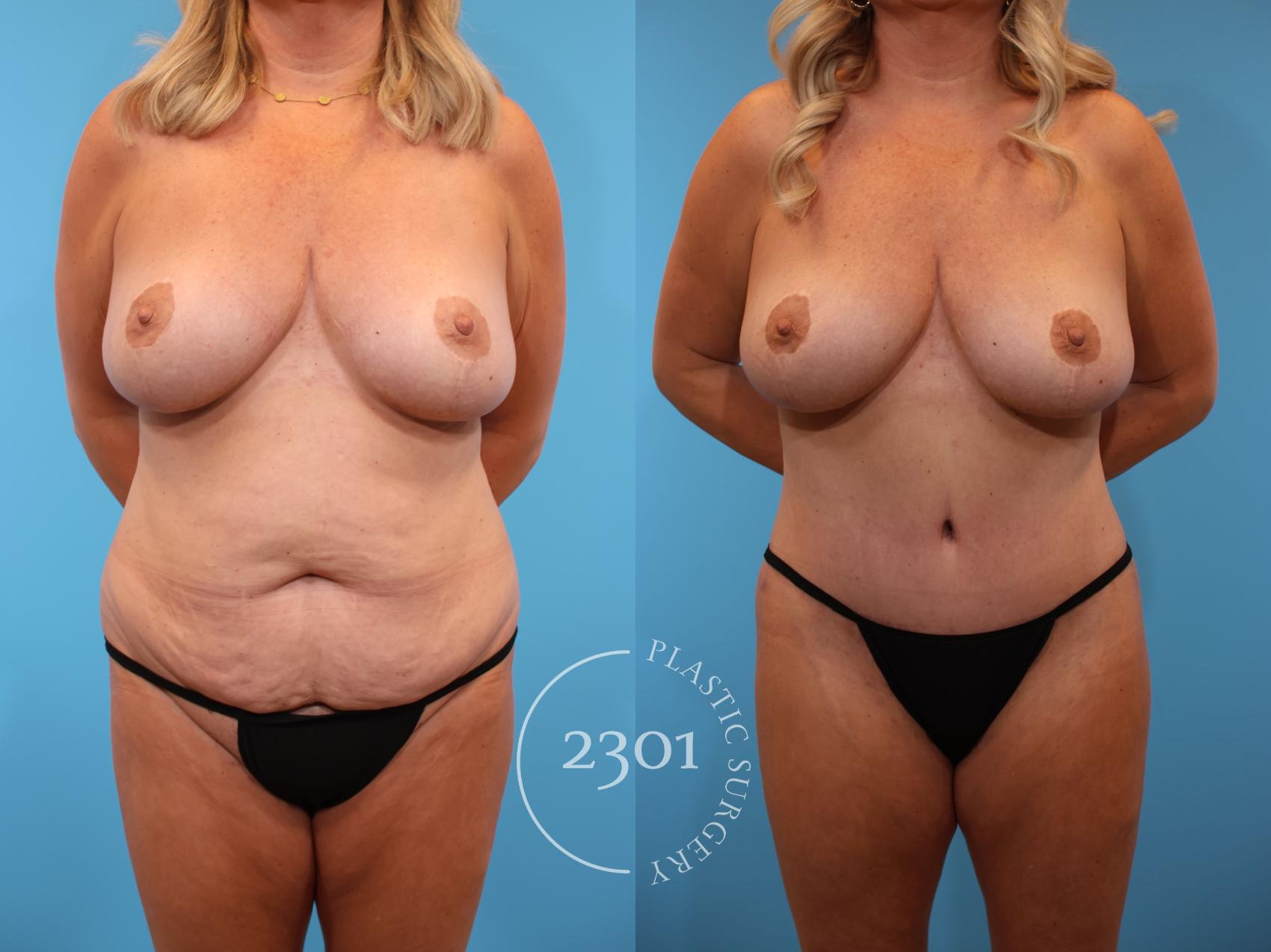 Before & After Tummy Tuck Case 914 Front View in Fort Worth, Plano, & Frisco, Texas