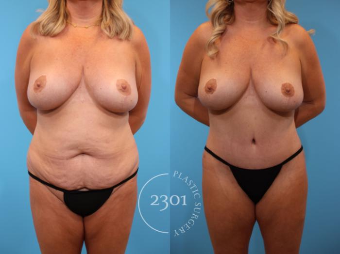 Before & After Tummy Tuck Case 914 Front View in Fort Worth, Plano, & Frisco, Texas