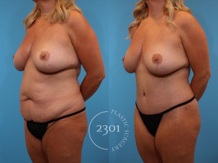 Before & After Tummy Tuck Case 914 Left Oblique View in Fort Worth, Plano, & Frisco, Texas