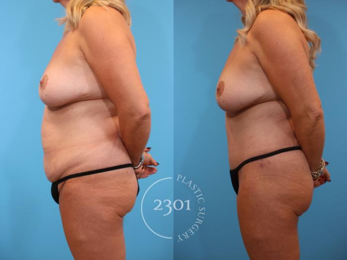 Before & After Tummy Tuck Case 914 Left Side View in Fort Worth, Plano, & Frisco, Texas