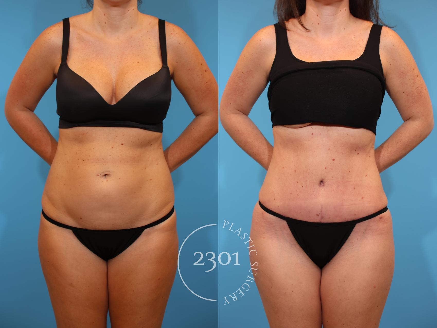 Before & After Tummy Tuck Case 926 Front View in Fort Worth, Plano, & Frisco, Texas