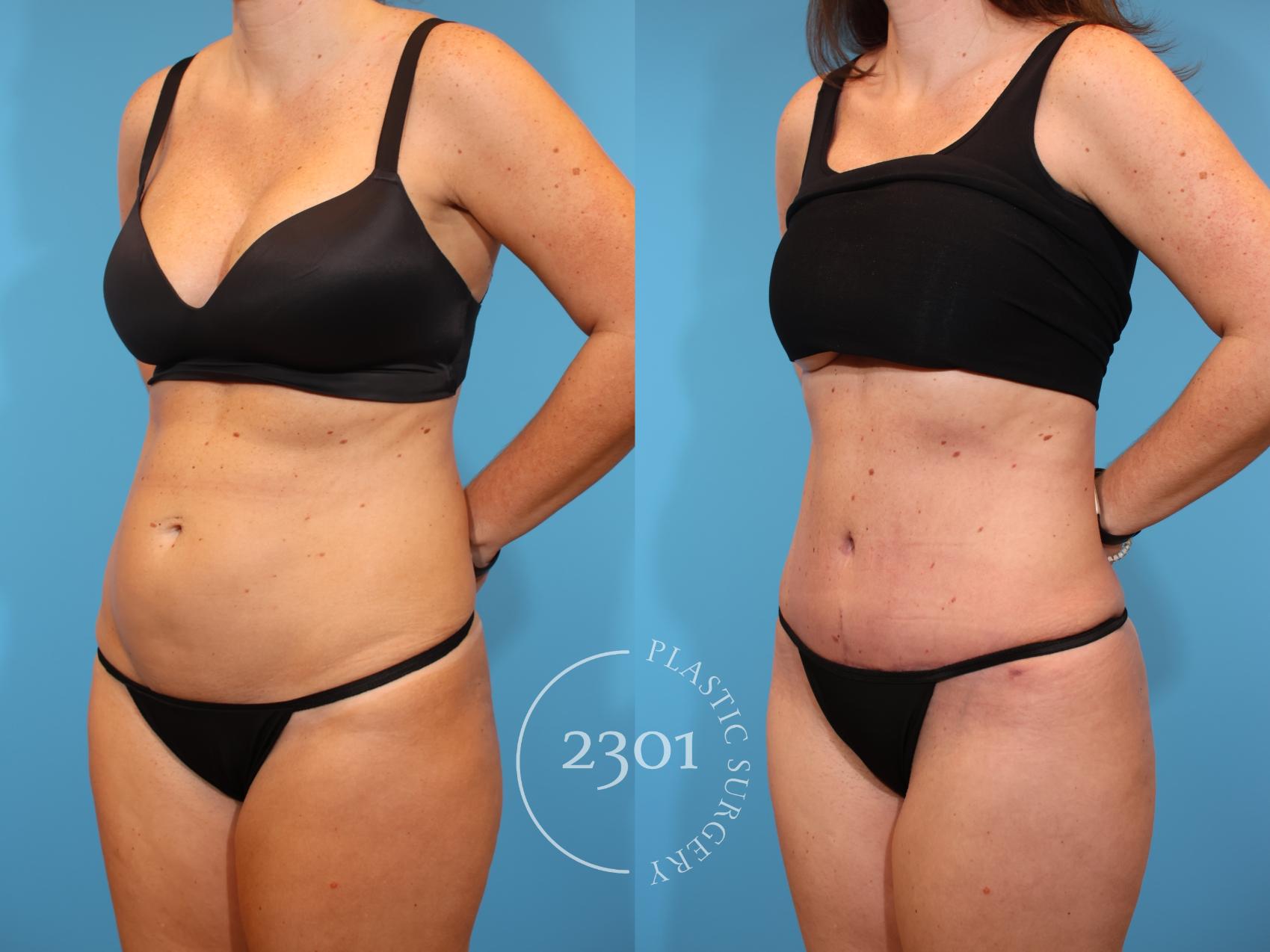 Before & After Tummy Tuck Case 926 Left Oblique View in Fort Worth, Plano, & Frisco, Texas