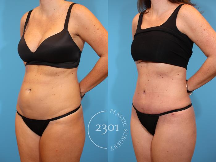 Before & After Tummy Tuck Case 926 Left Oblique View in Fort Worth, Plano, & Frisco, Texas