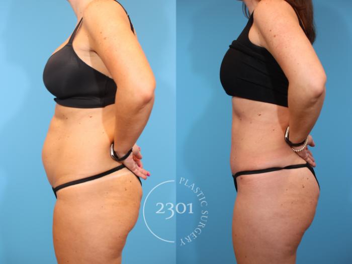 Before & After Tummy Tuck Case 926 Left Side View in Fort Worth, Plano, & Frisco, Texas