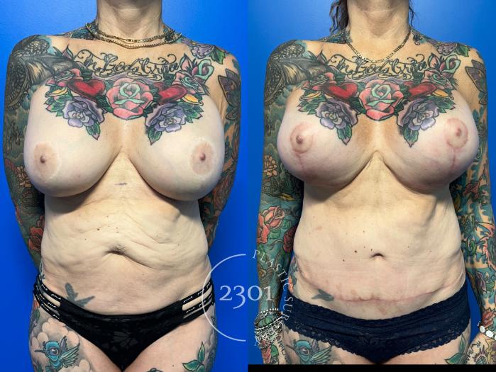 Before & After Mastopexy & Augmentation Case 959 Front View in Fort Worth, Plano, & Frisco, Texas