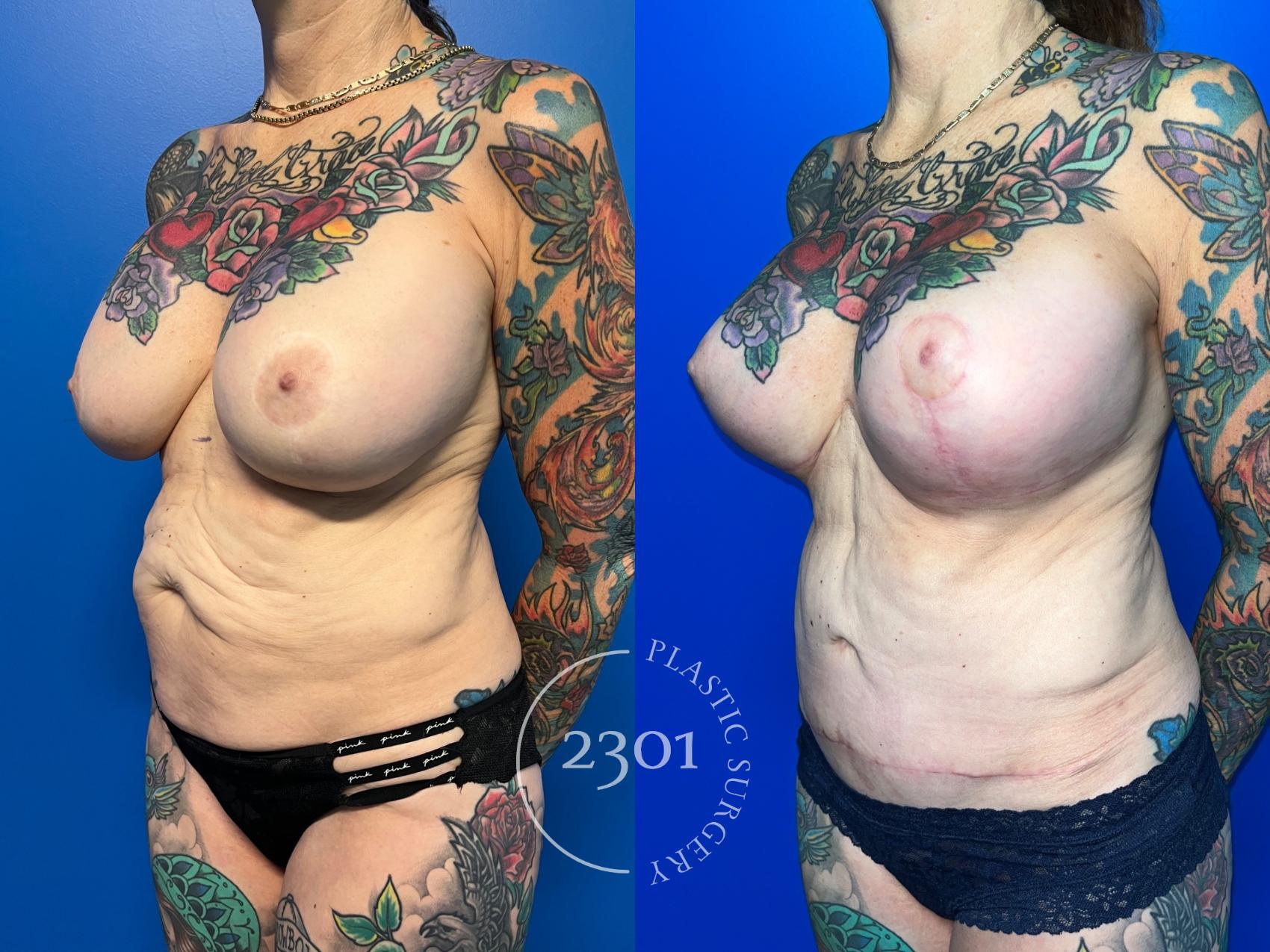 Before & After Tummy Tuck Case 959 Left Oblique View in Fort Worth, Plano, & Frisco, Texas