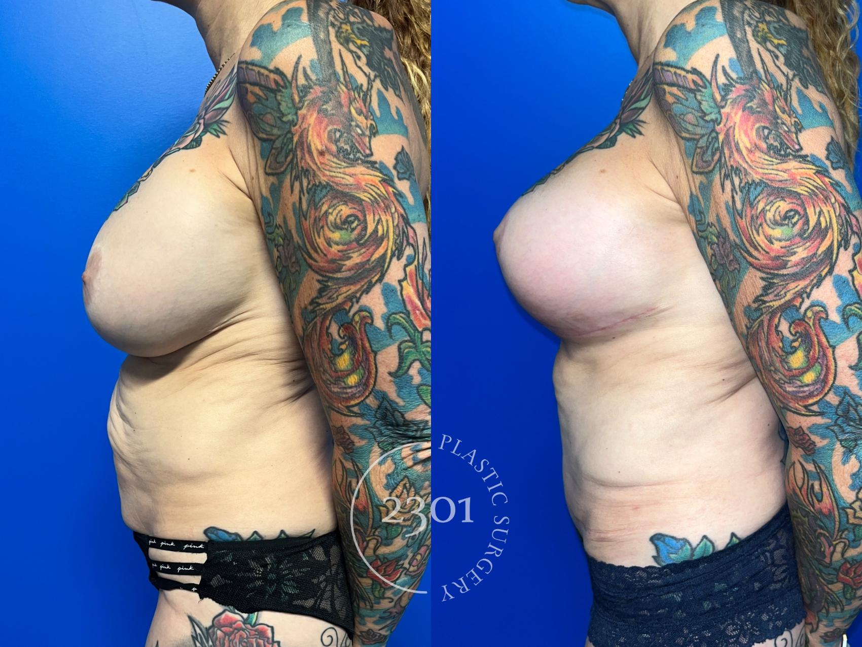 Before & After Tummy Tuck Case 959 Left Side View in Fort Worth, Plano, & Frisco, Texas