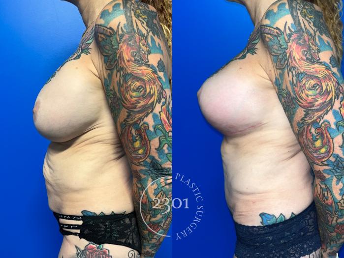 Before & After Tummy Tuck Case 959 Left Side View in Fort Worth, Plano, & Frisco, Texas