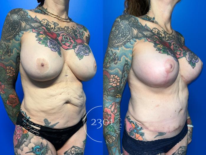 Before & After Tummy Tuck Case 959 Right Oblique View in Fort Worth, Plano, & Frisco, Texas
