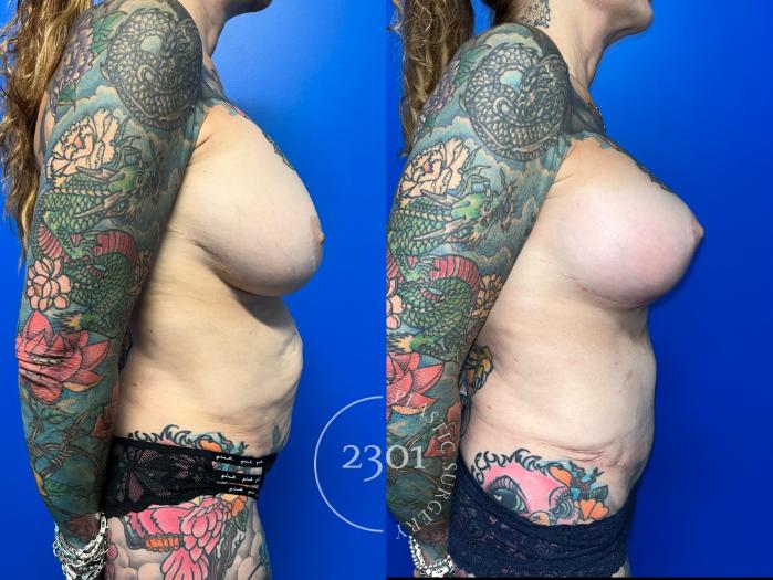 Before & After Tummy Tuck Case 959 Right Side View in Fort Worth, Plano, & Frisco, Texas