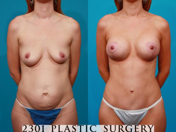 Before & After Breast Lift (Mastopexy) Case 96 View #1 View in Fort Worth, Plano, & Frisco, Texas