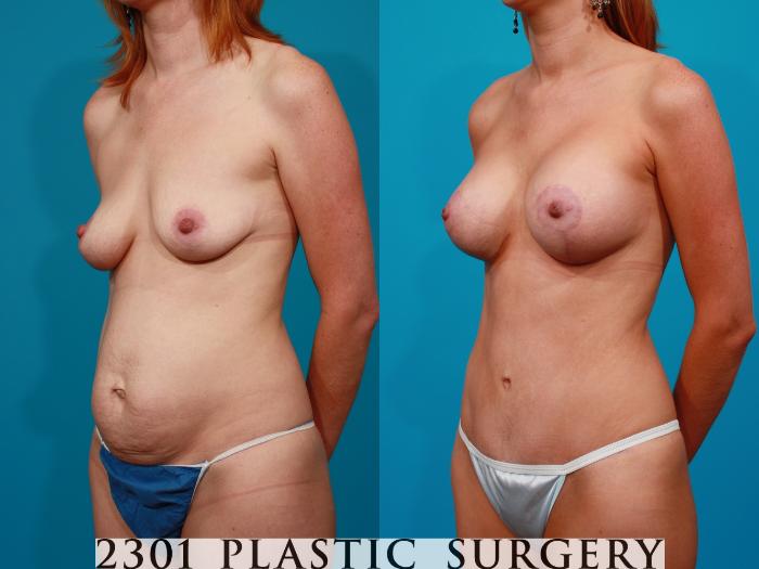Before & After Silicone Implants Case 96 View #3 View in Fort Worth, Plano, & Frisco, Texas