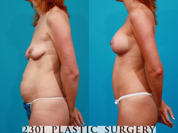 Before & After Silicone Implants Case 96 View #4 View in Fort Worth, Plano, & Frisco, Texas