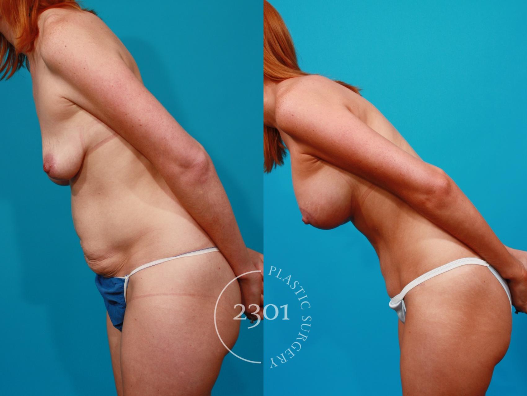 Before & After Breast Augmentation Case 96 View #5 View in Fort Worth, Plano, & Frisco, Texas