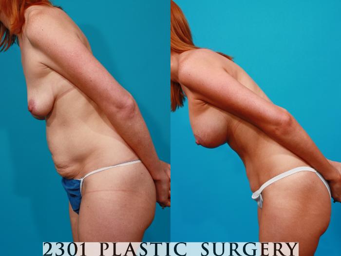 Before & After Silicone Implants Case 96 View #5 View in Fort Worth, Plano, & Frisco, Texas