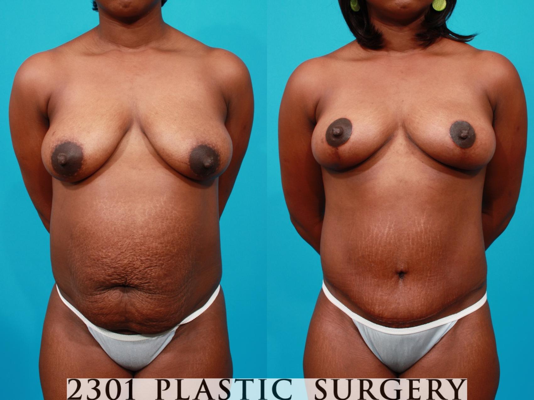 Before & After Tummy Tuck - Extended Case 137 View #1 View in Fort Worth, Plano, & Frisco, Texas