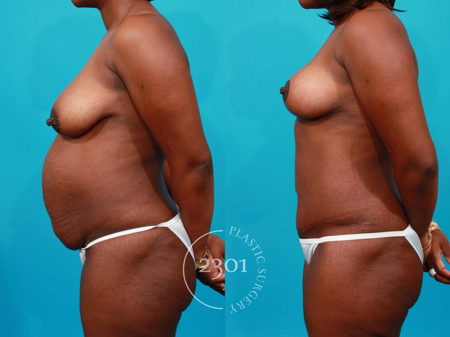 Before & After Breast Lift (Mastopexy) Case 137 View #2 View in Fort Worth, Plano, & Frisco, Texas
